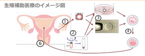 生殖補助医療のイメージ図